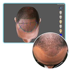 What To Do After Hair Transplant? | Simone Trichology Hair Trasplant SIMONE TRICHOLOGY