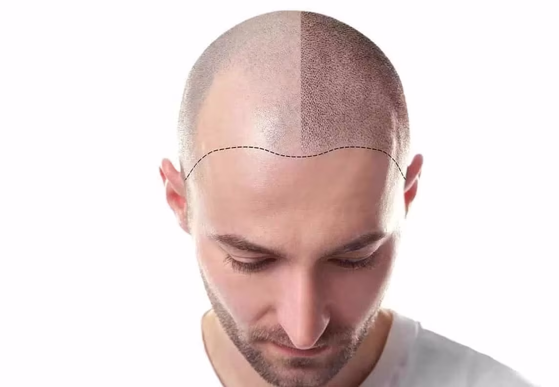 Injerto capilar - SIMONE TRICHOLOGY