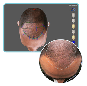 Hair Trasplant SIMONE TRICHOLOGY