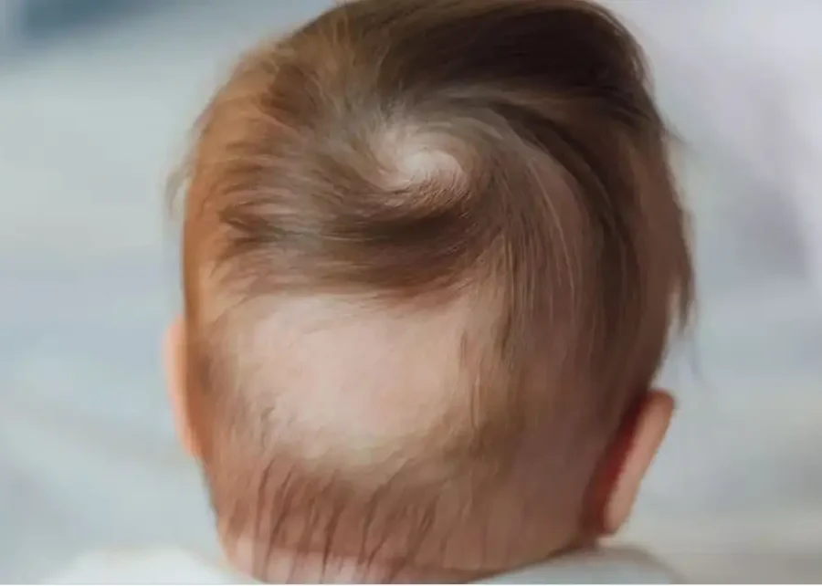Cabelo de uma criança a ser examinado — queda de cabelo nas crianças