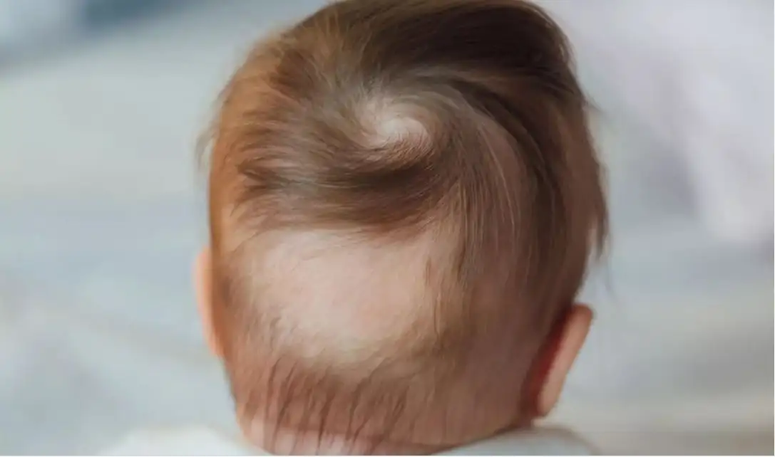 Hair loss in children — when it is normal and when to seek advice