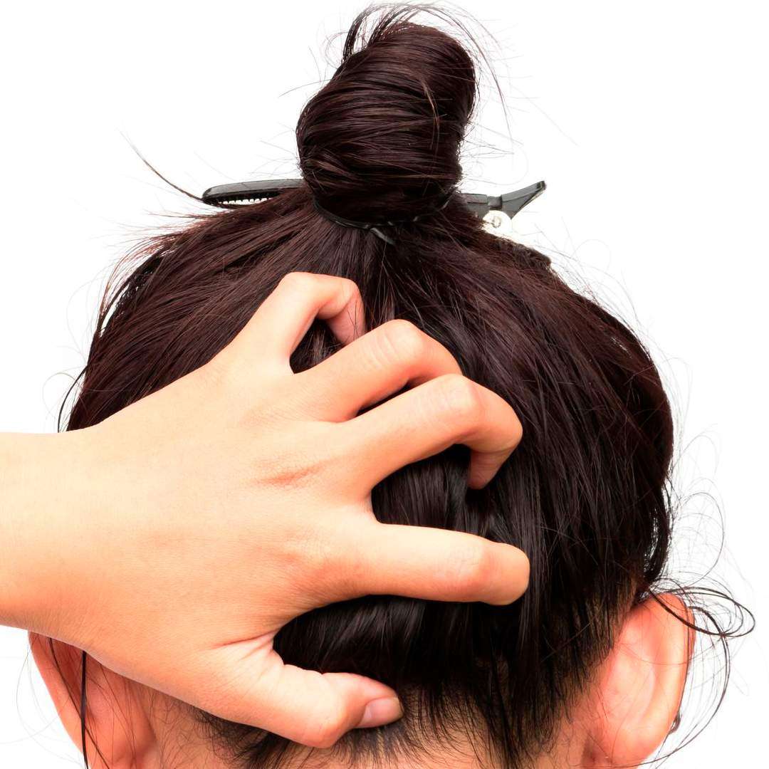 Seborrhea and greasy scalp care — SIMONE TRICHOLOGY