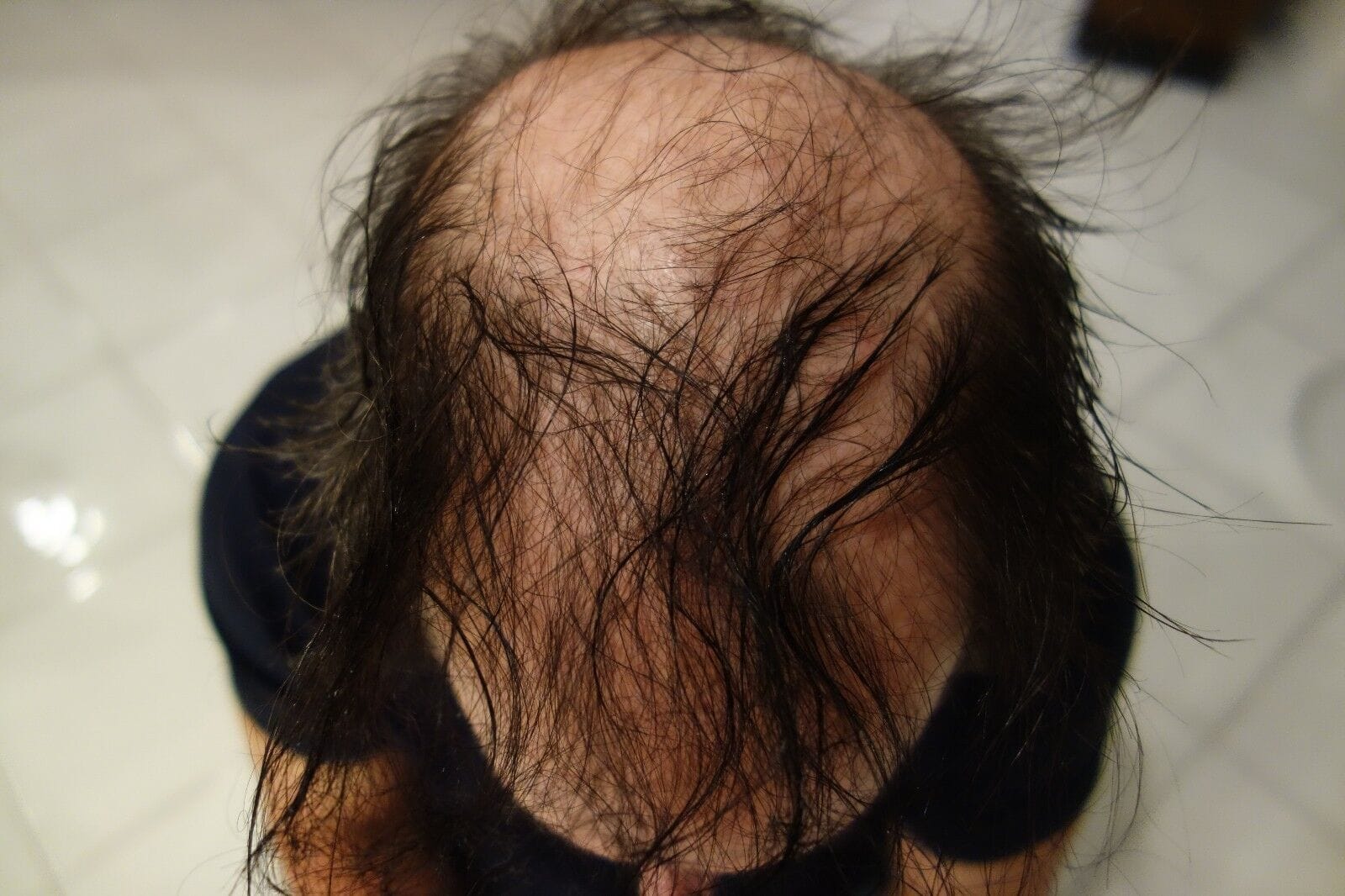 INFECTIOUS ALOPECIA