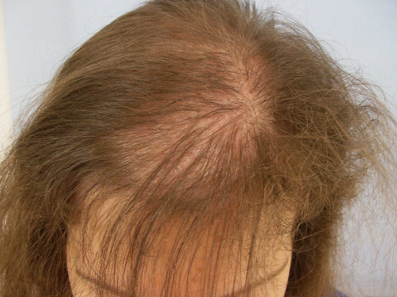 MENOPAUSAL HAIR LOSS