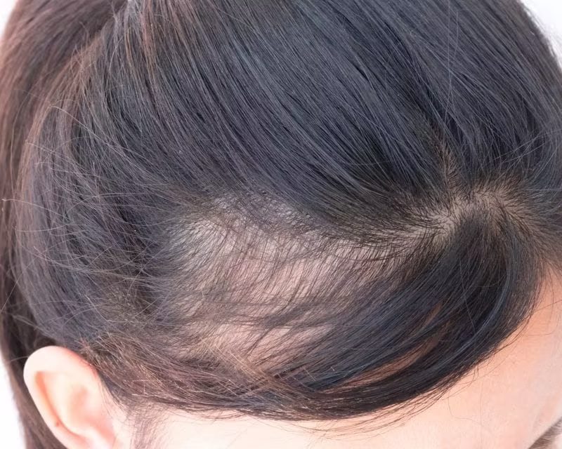 POST-TRAUMATIC ALOPECIA
