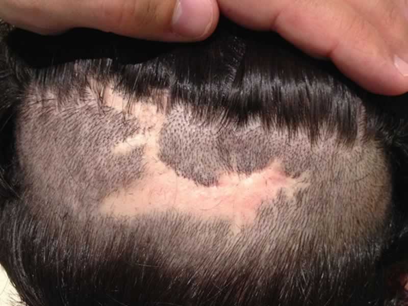 SCARING ALOPECIA II