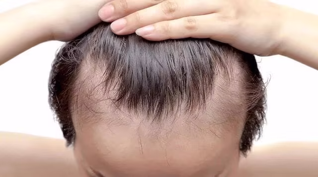 HAIR LOSS AND ALOPECIA | SIMONE TRICHOLOGY