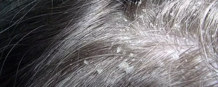 PITYRIASIS SIMPLEX CAPITIS | SIMONE TRICHOLOGY