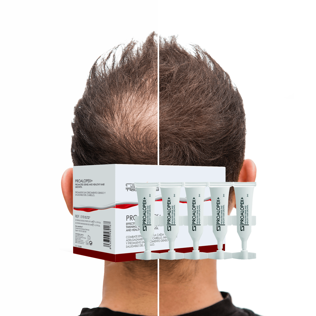 PROALOPEX+: Revolucionando el cuidado del cabello para la alopecia androgenética y el cuidado post-trasplante