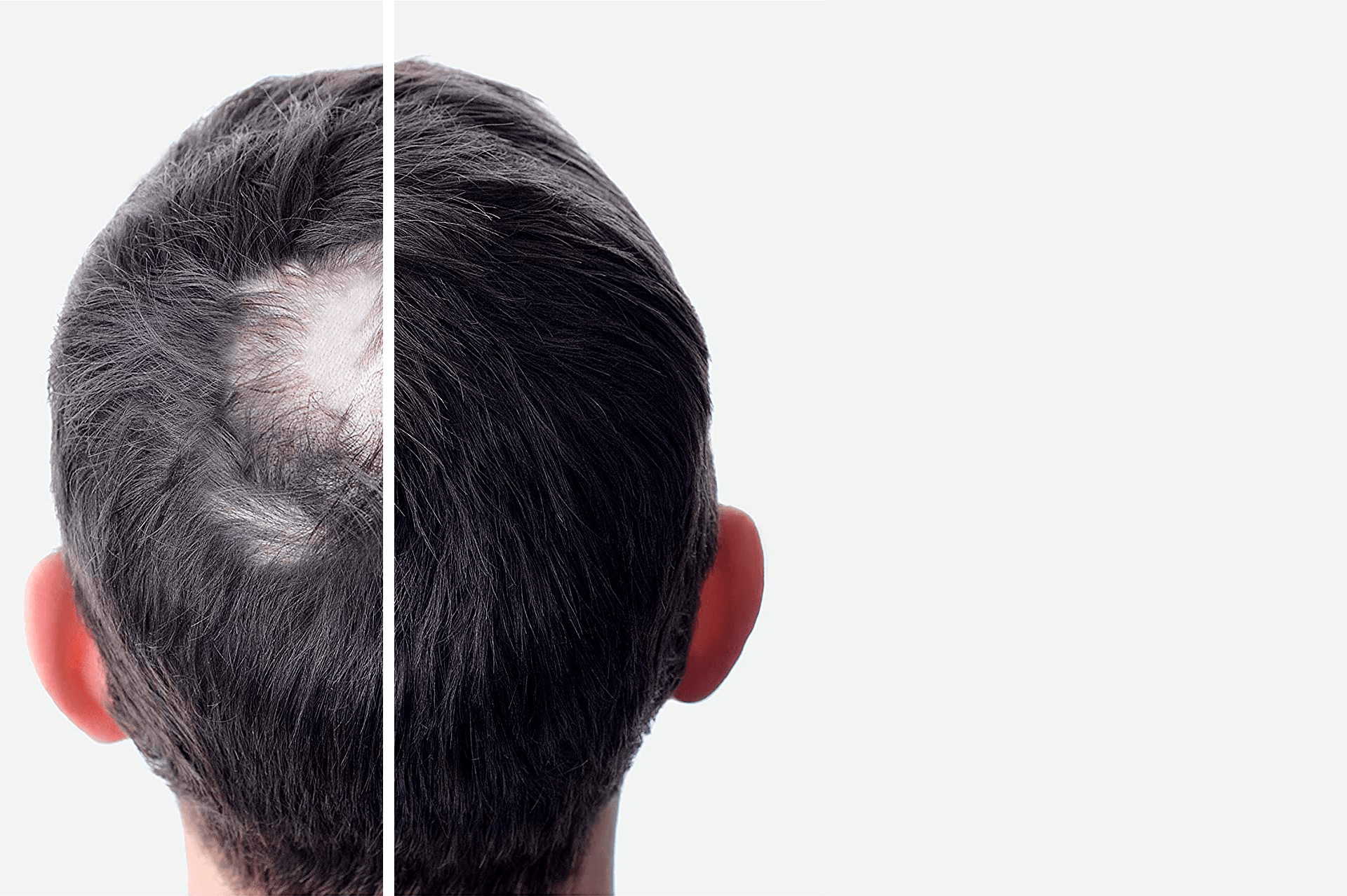 HAIR LOSS AFTER-BEFORE with SIMONE TRICHOLOGY