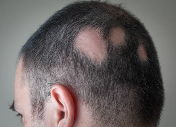 ALOPECIA AREATA IN MULTIPLE PLATES ALOPECIA AREATA IN MULTIPLE PLATES