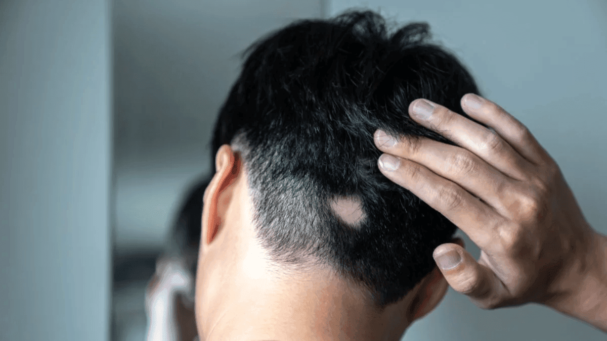 ALOPECIA AREATA SIMPLE ALOPECIA AREATA SIMPLE