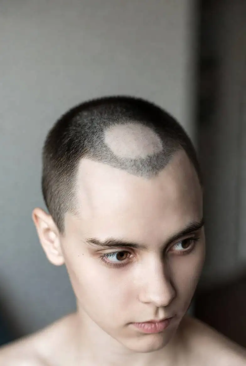 ¿Qué tipo de técnica o tratamiento existe para la alopecia areata?