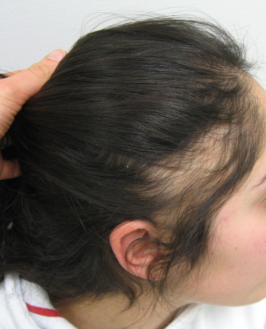 Fringe sign in traction alopecia
