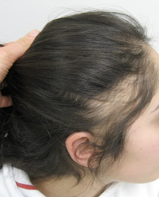 Fringe sign along the hairline — a typical sign of traction alopecia