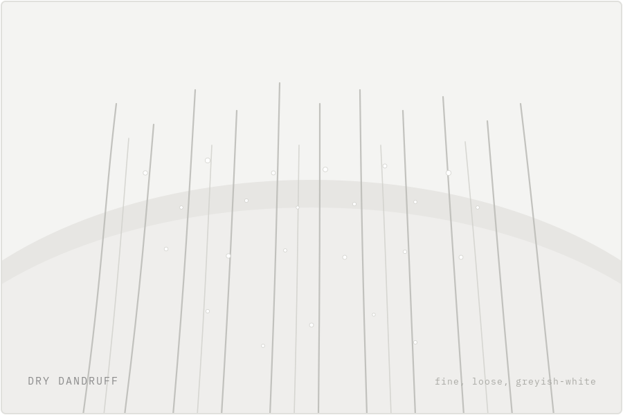 Dry dandruff illustration — fine greyish-white flakes on the scalp — SIMONE TRICHOLOGY