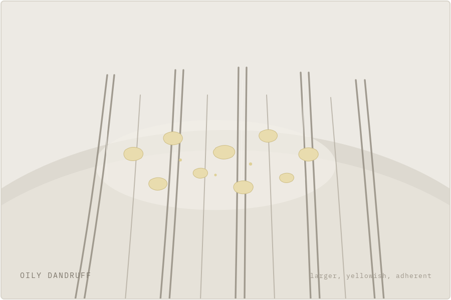 Oily dandruff illustration — larger yellowish adherent flakes on an oily scalp — SIMONE TRICHOLOGY
