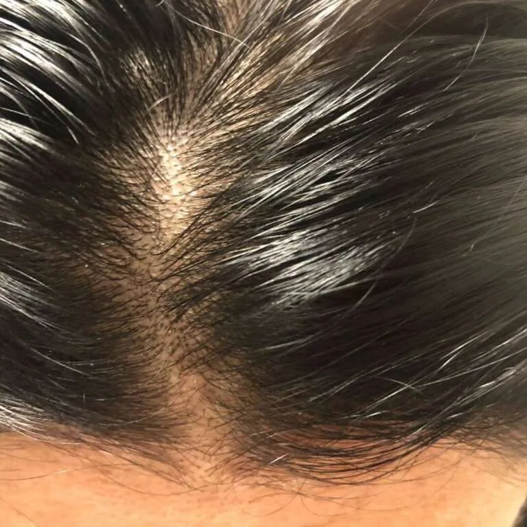 Close-up of a person's scalp with visibly thinning dark hair, showing a widened part and noticeable scalp underneath, possibly indicating seborrhea in scalp.