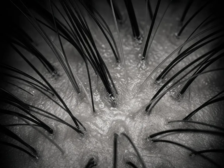 Trichoscopy view of scalp hair follicles with sebum