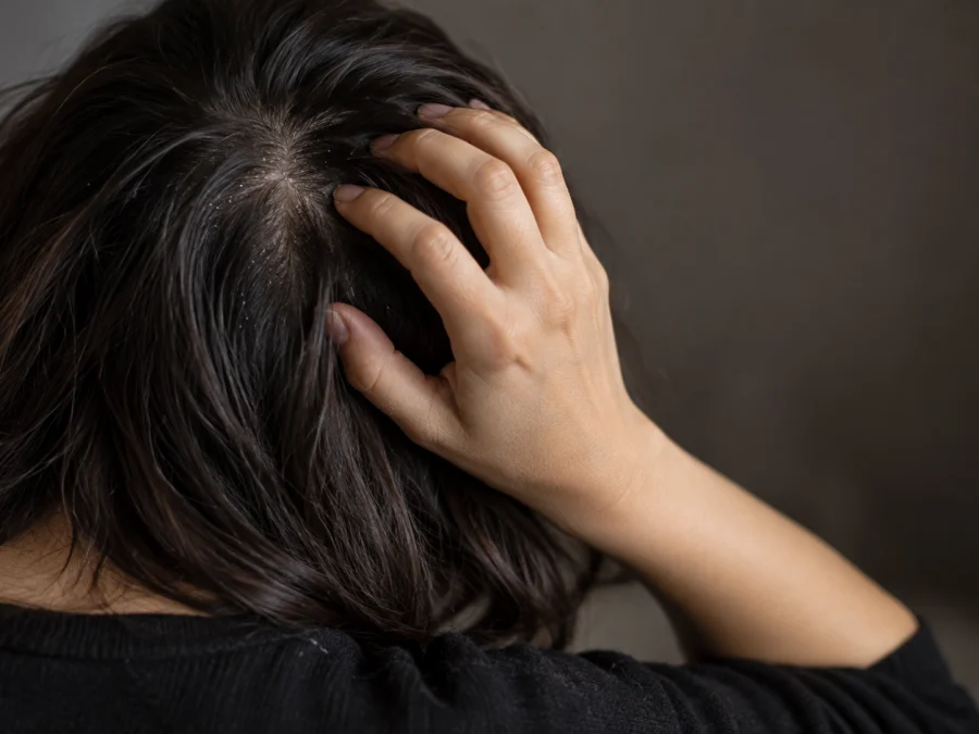 Itchy scalp and dandruff: woman with dark shoulder-length hair seen from behind, fingertips pressed into the scalp at the crown, small white flakes visible along the parting — SIMONE TRICHOLOGY