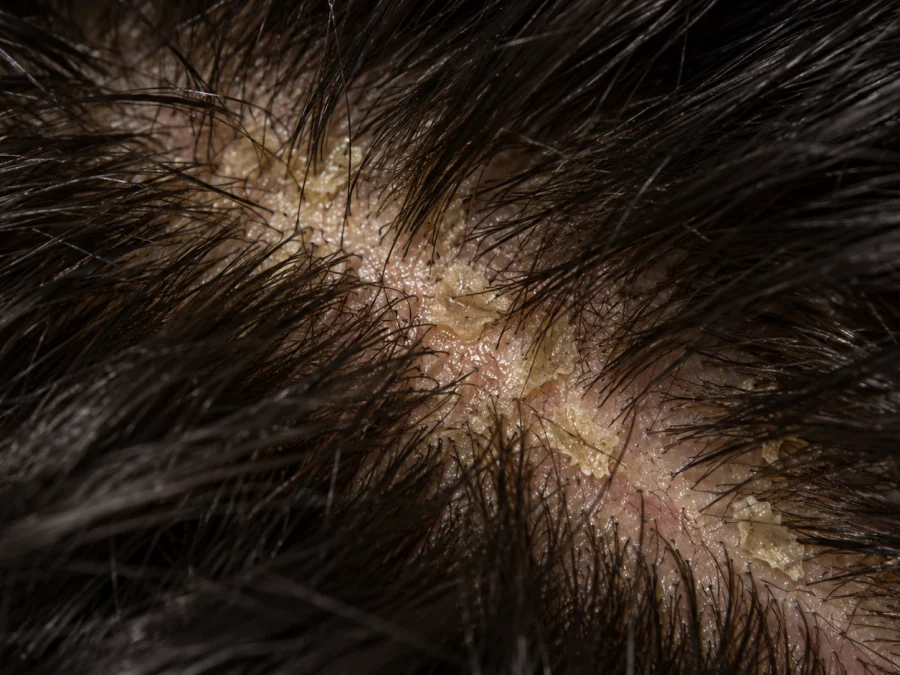 Oily dandruff: larger yellowish, greasy flakes stuck to a shiny scalp and to the base of the hairs along a diagonal parting, close-up — SIMONE TRICHOLOGY