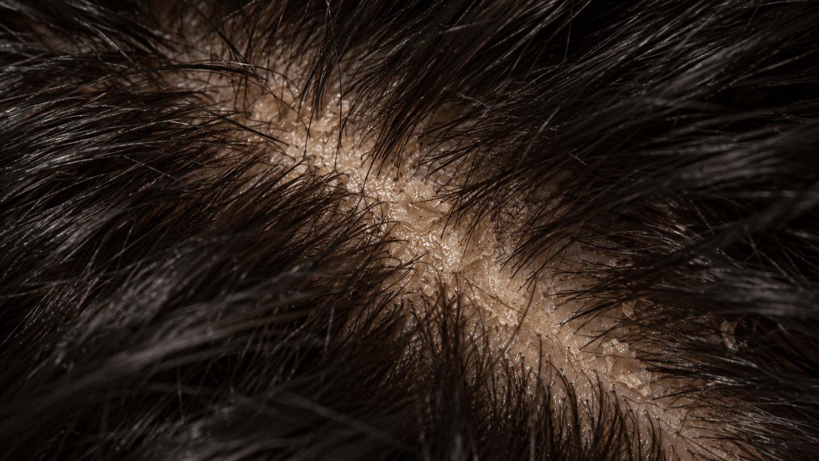 Oily dandruff: yellowish, greasy flakes stuck to a shiny scalp