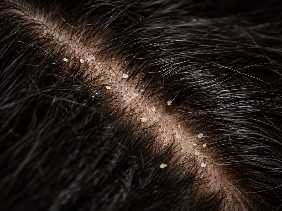Dry dandruff: small, loose white flakes scattered along a diagonal parting on a dark-haired scalp, close-up — SIMONE TRICHOLOGY