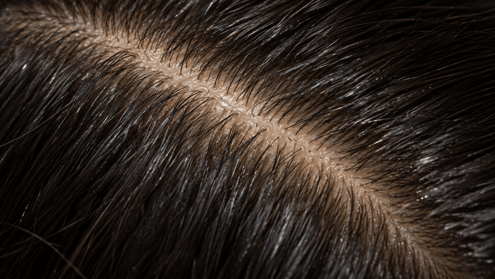Oily scalp (seborrhea): straight parting in dark hair with visible sebum shine