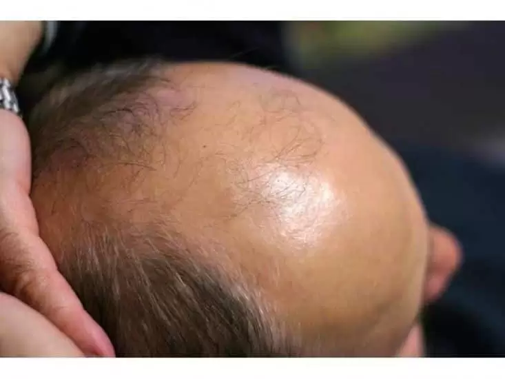 ANDROGENIC ALOPECIA