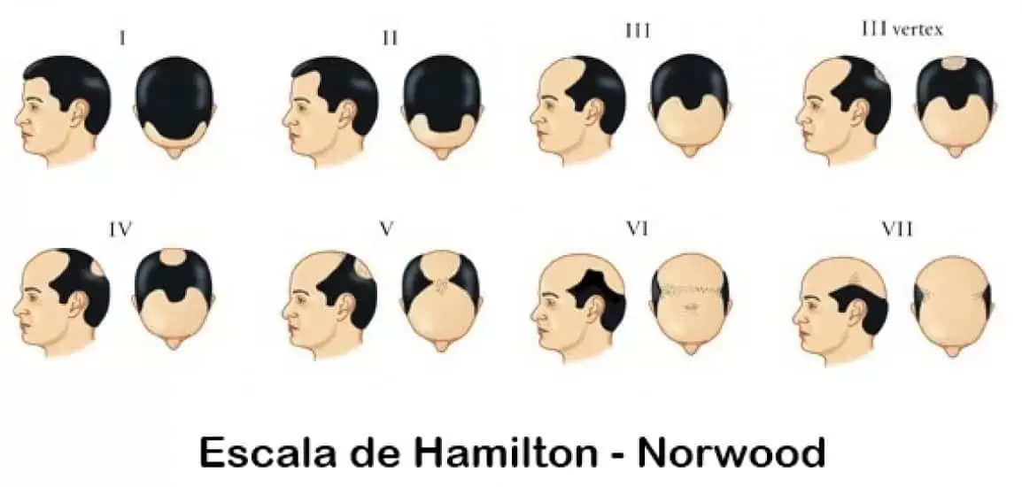 HAMILTON SCALE