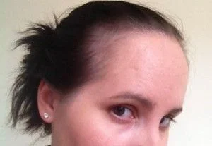 POST-PARTUM ALOPECIA