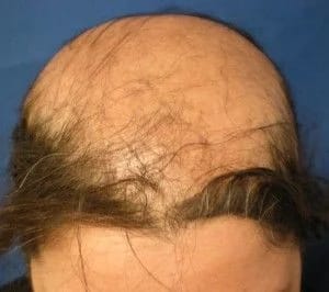 SCARING ALOPECIA